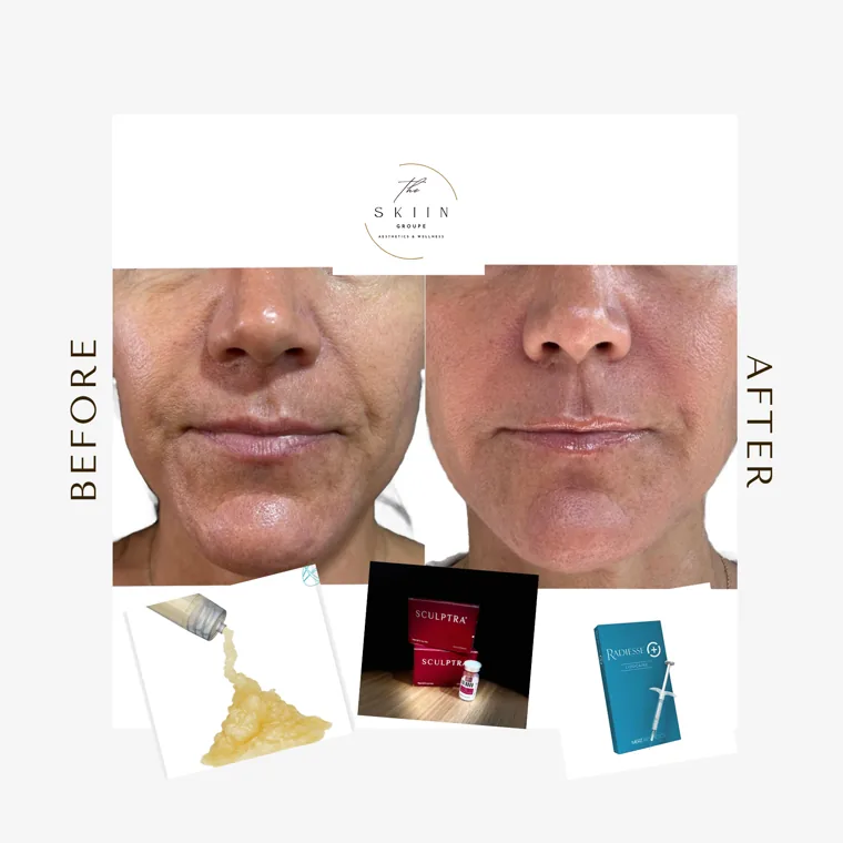 Before and after of a Sculptra biostimulator full-face treatment at The SKIIN Groupe