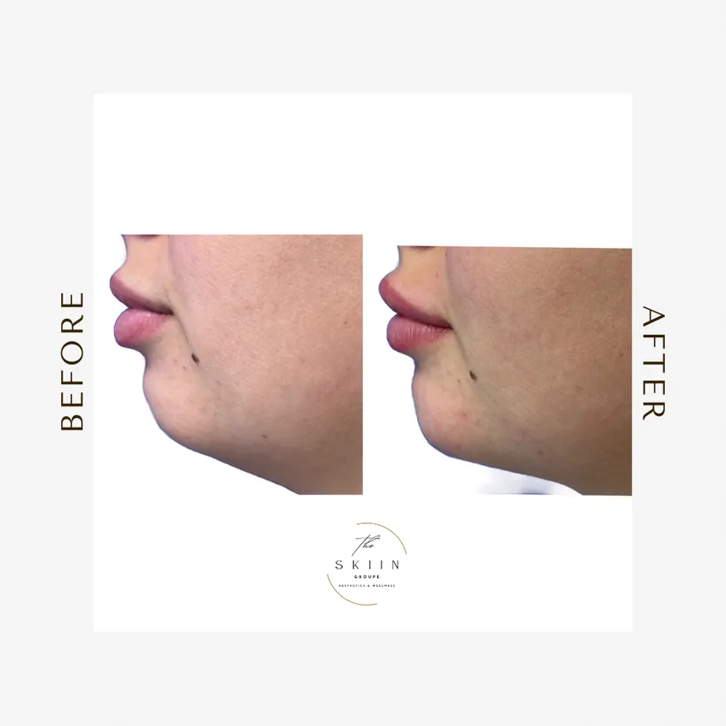 Before and after of chin augmentation with Juvéderm Ultra XC improving profile balance