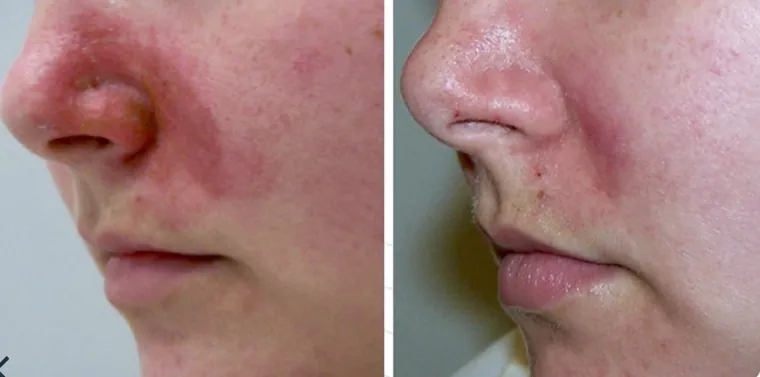 Before and after of calibrated pulse light treatment reducing rosacea redness around the nose and cheeks