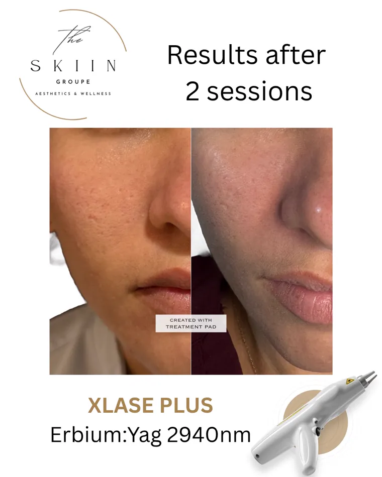 Before and after of XLase Plus Erbium:YAG fractional laser results after two sessions