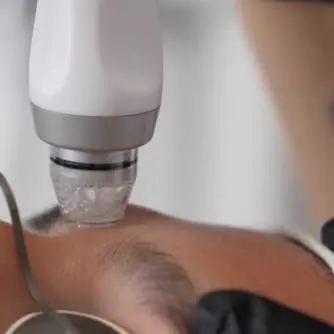 Precision laser treatment close-up near the brow